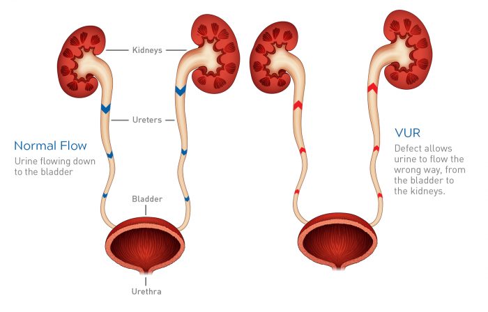 vesicoureteral-kidney-reflux-information