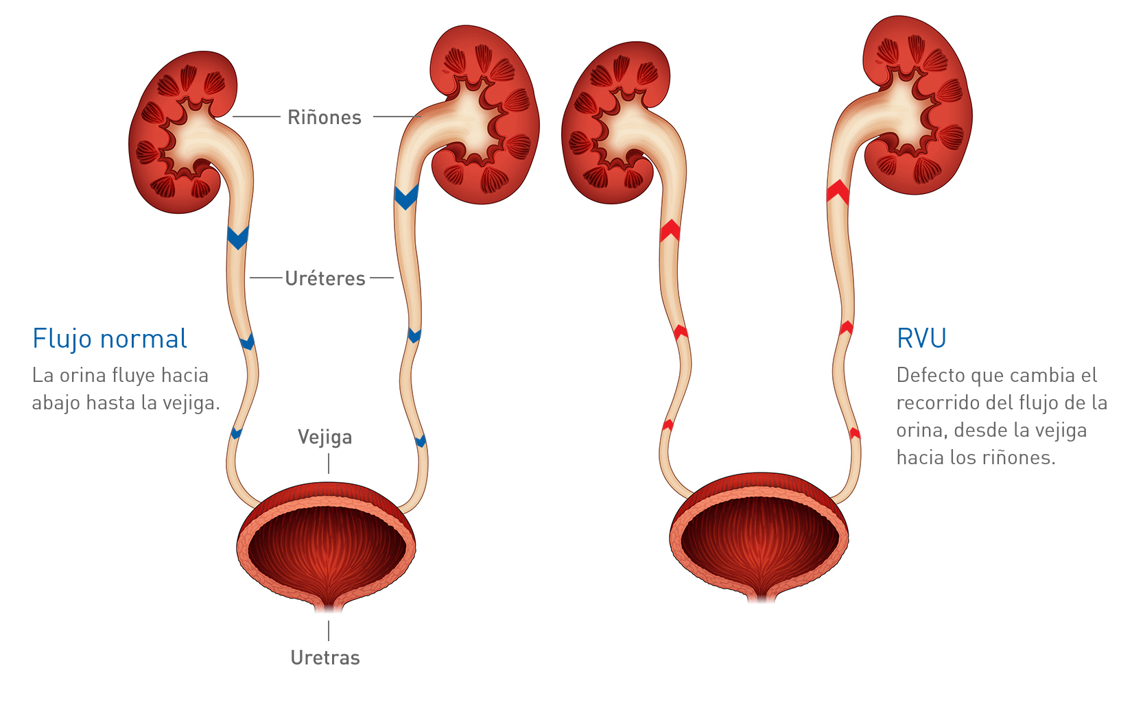 Рефлюкс при беременности. Ureter. Почки и мочеточники.